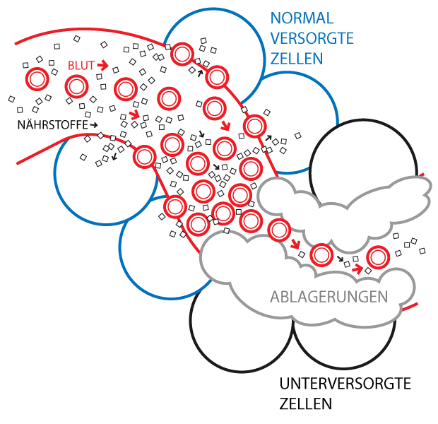 Wirkung der Arteriosklerose im Gef&auml;&szlig;system