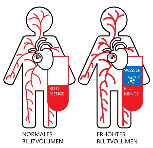 Entstehung von Bluthochdruck aufgrund zu hohem Kochsalzkonsum