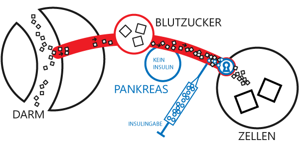 Schematische Darstellung des Diabetes mellitus Typ 1