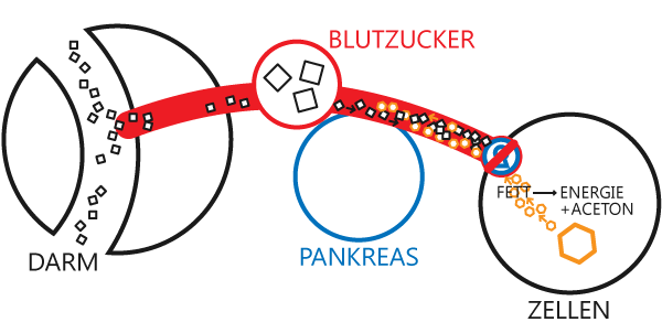 Ketoaszidotische Form der Unterzuckerung